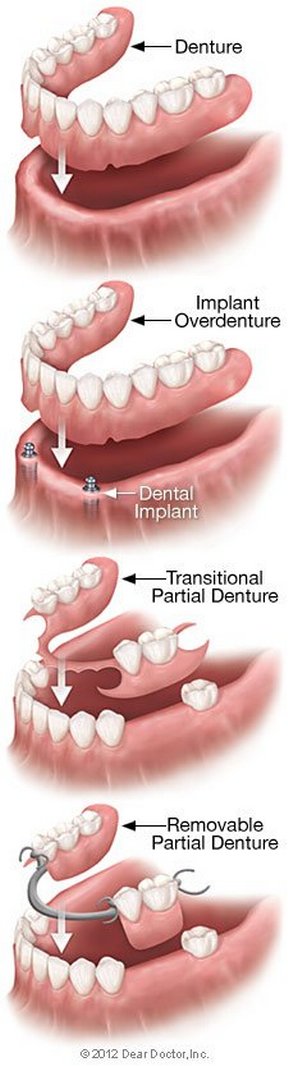 types of dentures Bellmore, NY