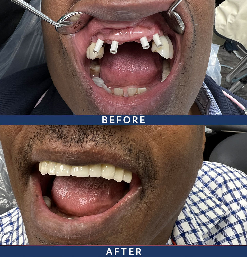 before after full arch