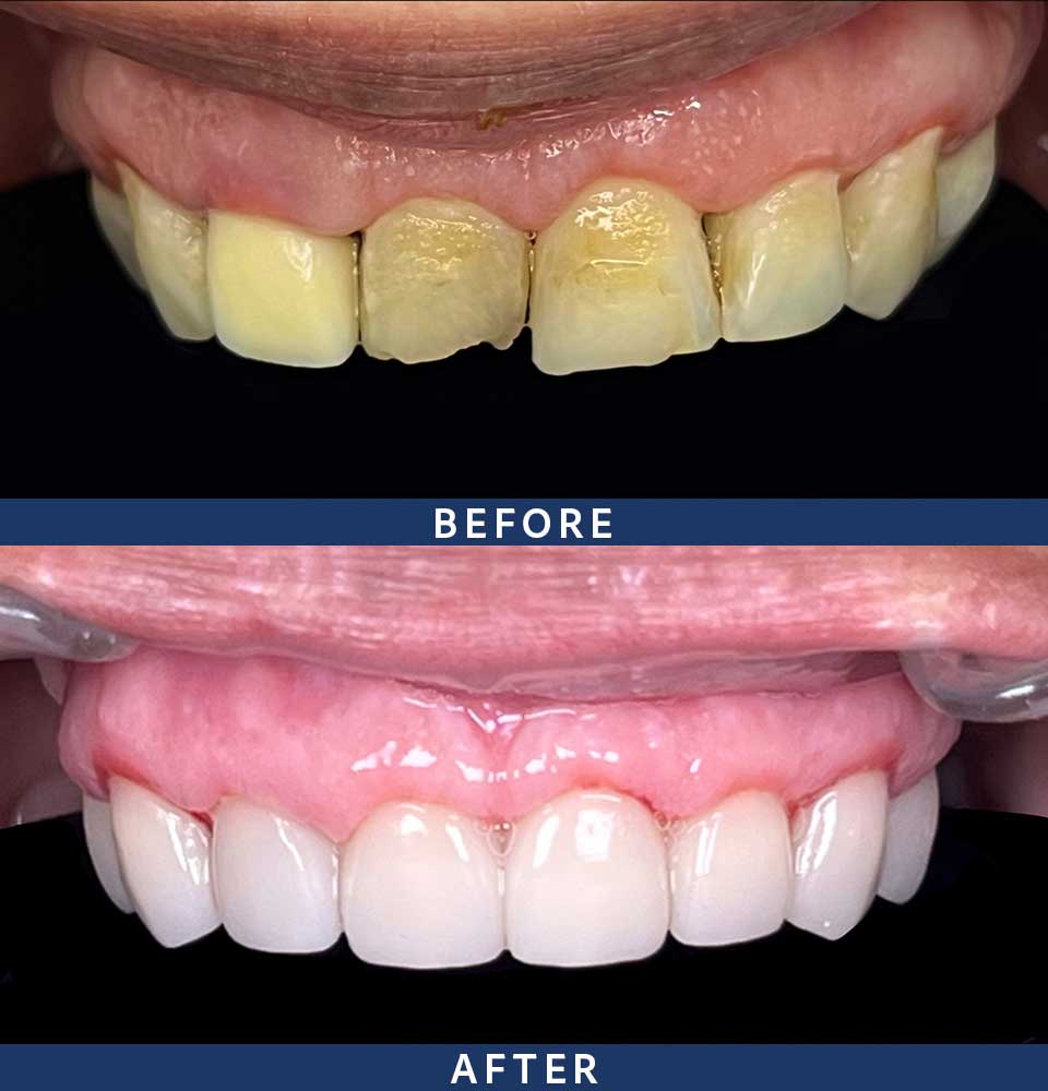 Full Mouth Dental Implants Patient - 001