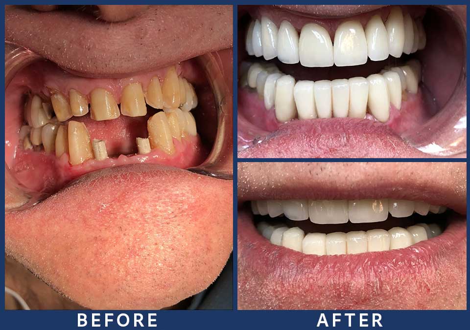 Full Mouth Dental Implants Patient - 002