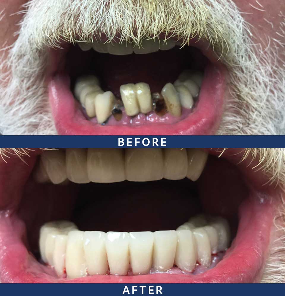 Full Mouth Dental Implants Patient - 003