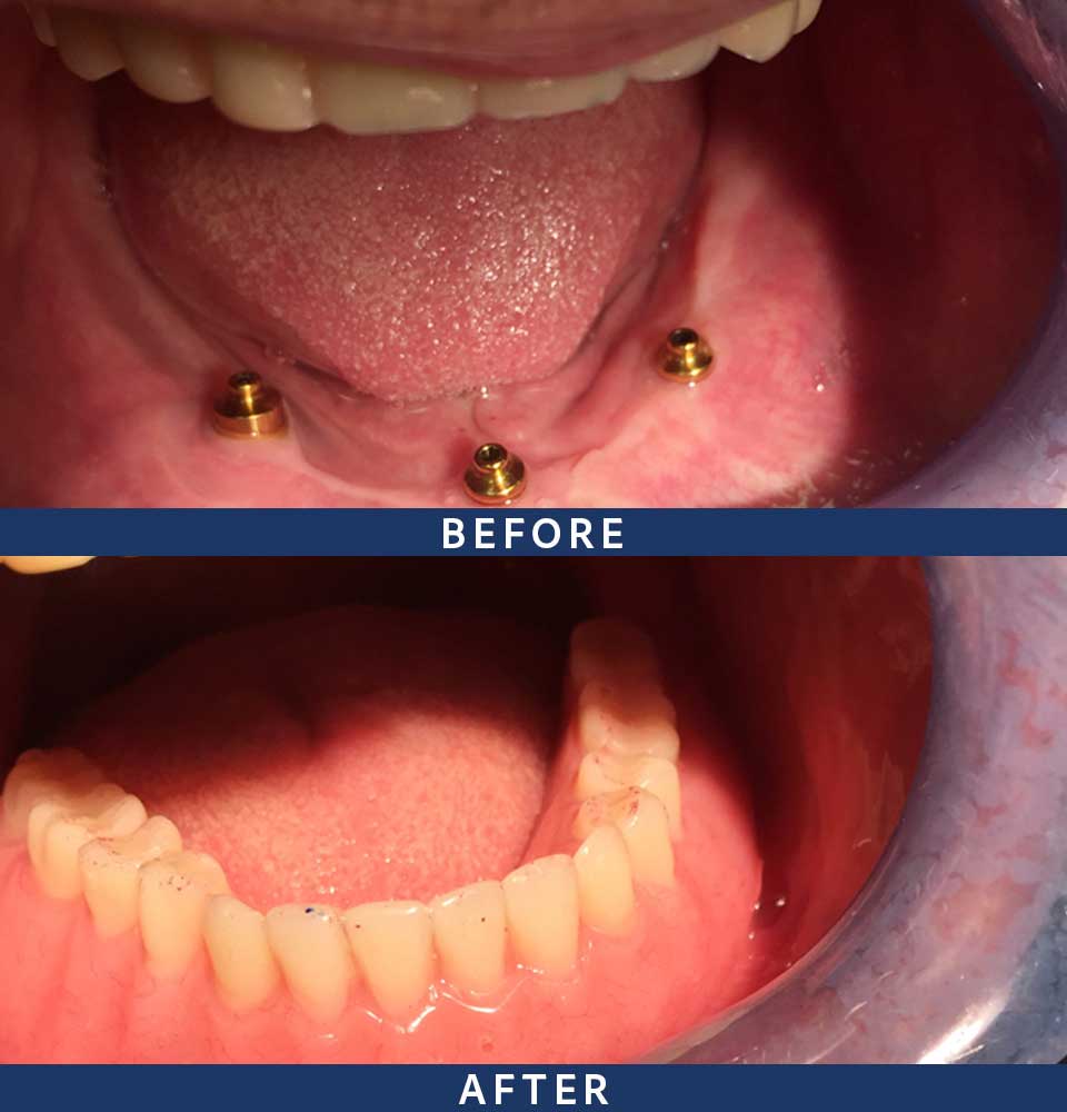 Full Mouth Dental Implants Patient - 004