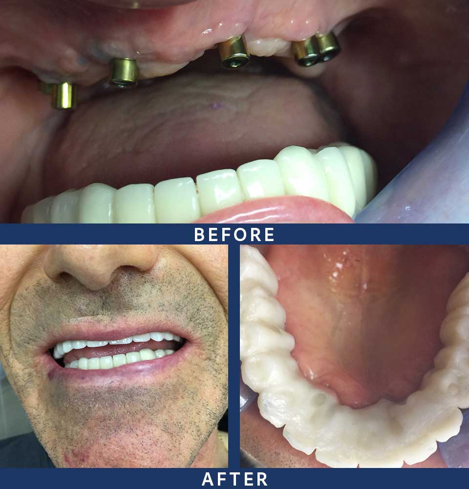 Full Mouth Dental Implants Patient - 005