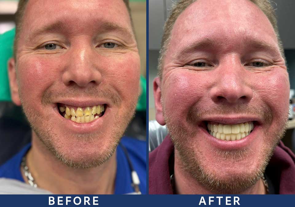 Full Mouth Dental Implants Patient - 006