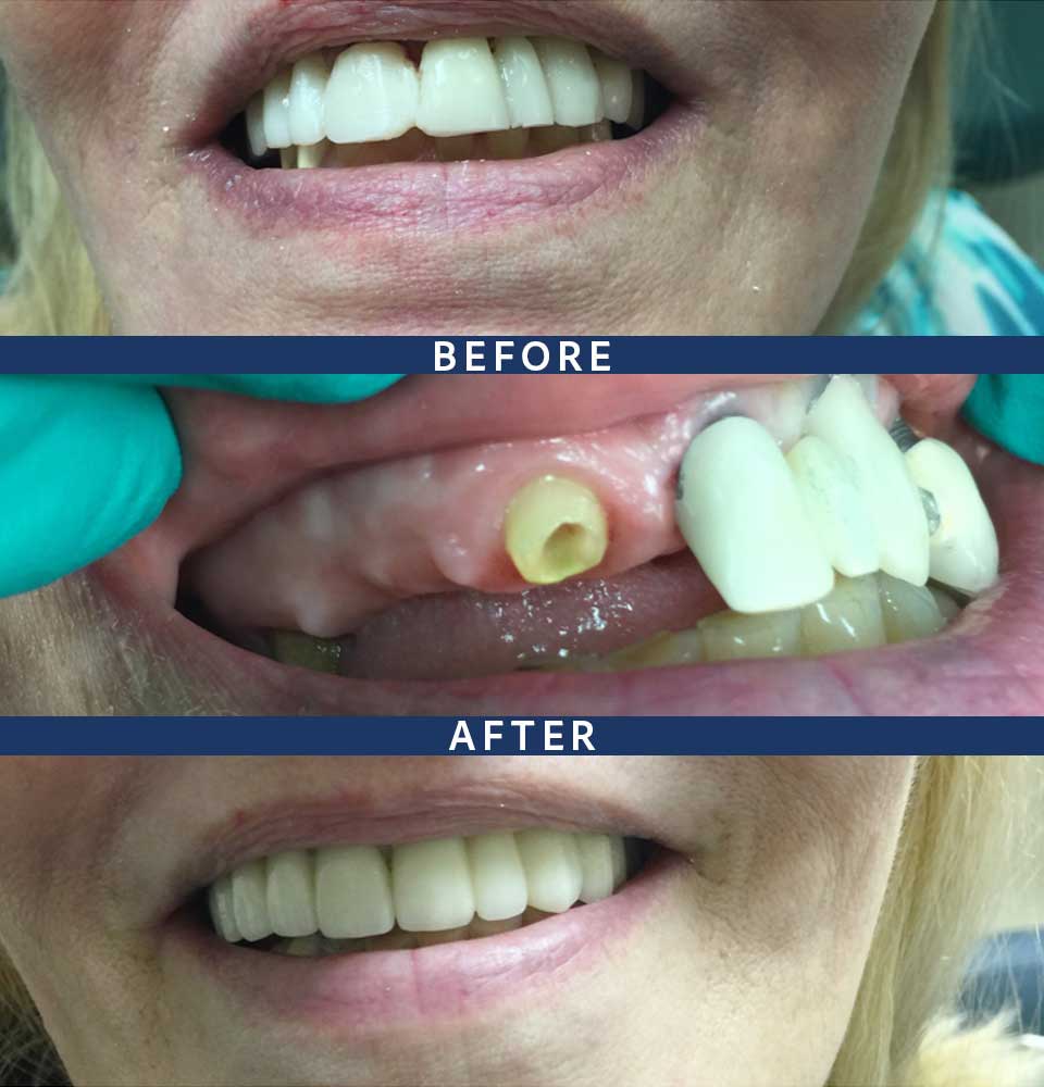 Full Mouth Dental Implants Patient - 007