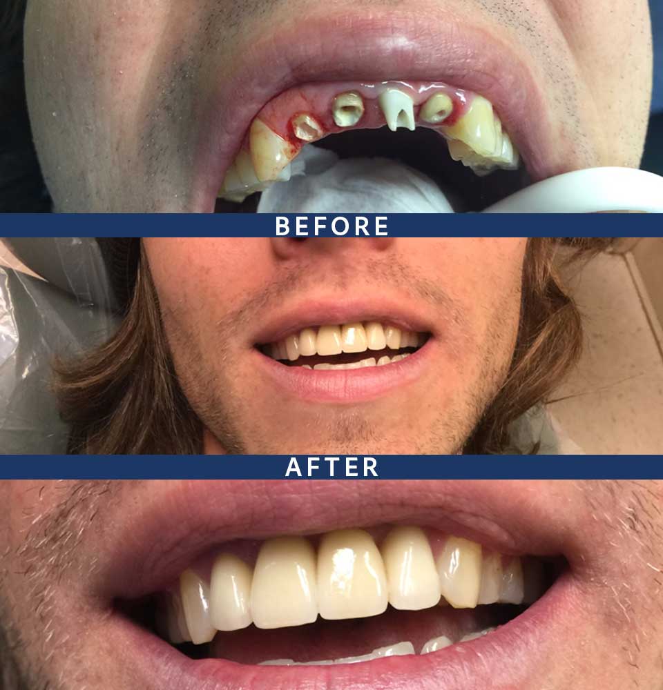 Full Mouth Dental Implants Patient - 008