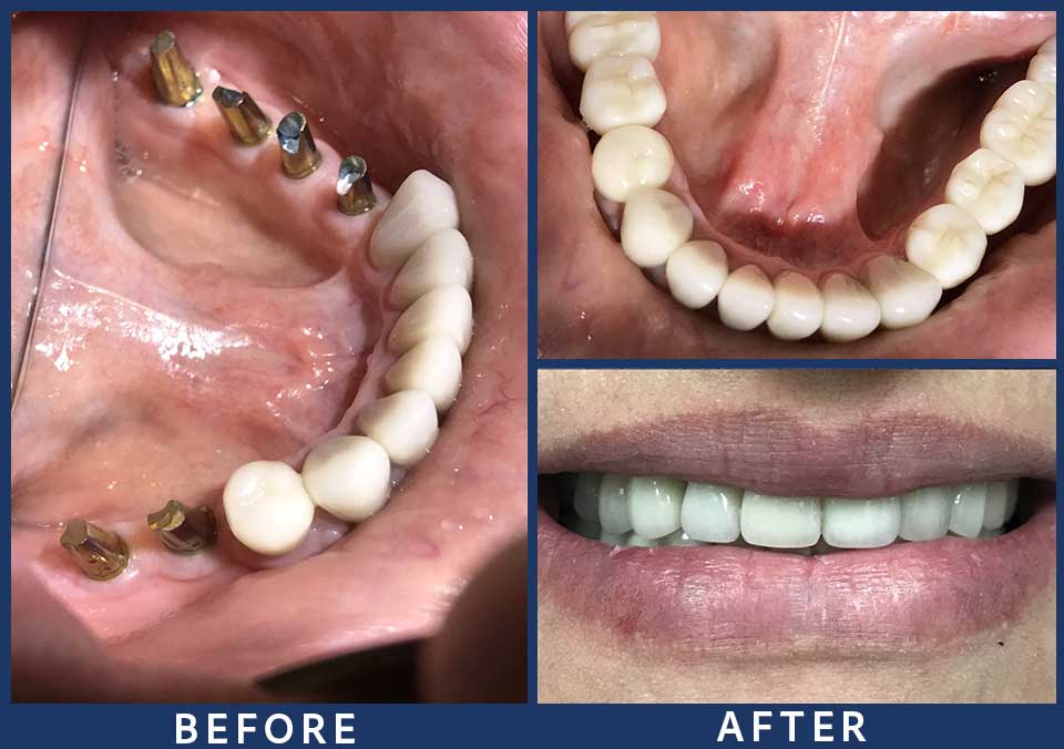 Full Mouth Dental Implants Patient - 009
