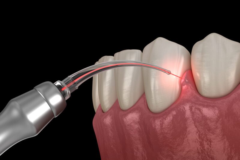 laser-gum-procedure